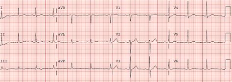 Dr. Smith's ECG Blog: Unstable Angina: Again, it still exists......