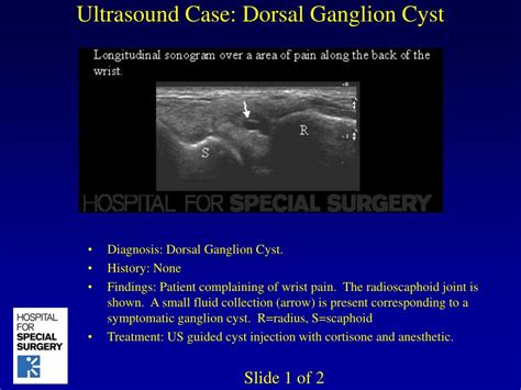 PPT - Ultrasound Case: Dorsal Ganglion Cyst PowerPoint Presentation ...