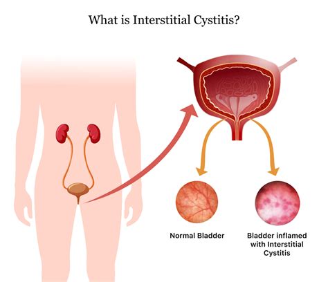 Interstitial Cystitis | Symptoms, Causes, Treatment & Living With IC