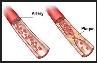 Peripheral Vascular Disease Treatment Service in Dadar West, Mumbai ...