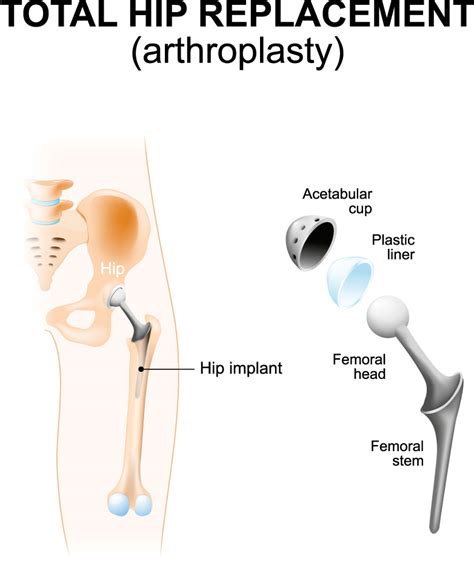 Hip Replacement Surgery (Total Hip Arthroplasty) - Schulze Orthopedics