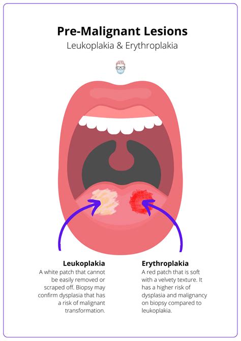 Oral Cavity Tumours · Types, Staging, Treatment, Anatomy