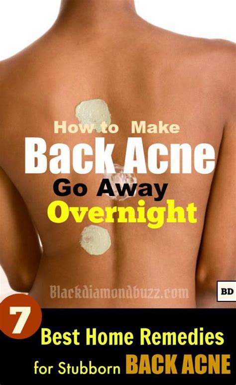 How to Get Rid of Back Acne Fast – 7 Best Home Remedies for Backne ...