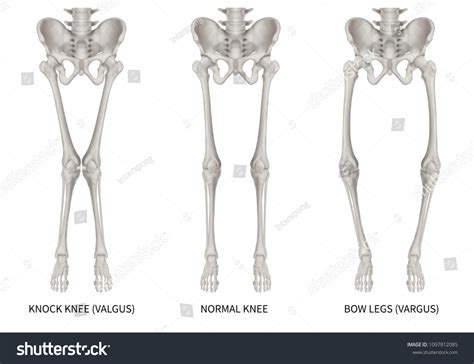 326 Varus Deformity Images, Stock Photos, 3D objects, & Vectors ...