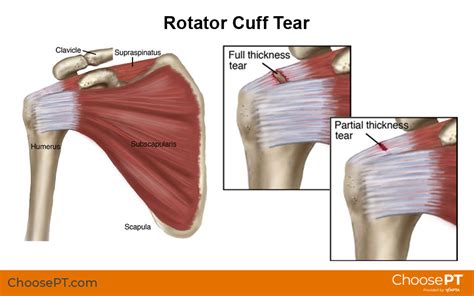 Supraspinatus Muscle Tear