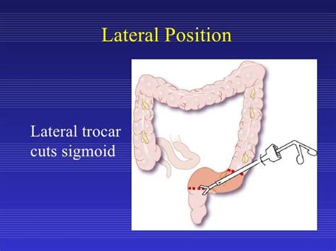 Laparoscopic Sigmoid Colon Resection for Diverticular Disease