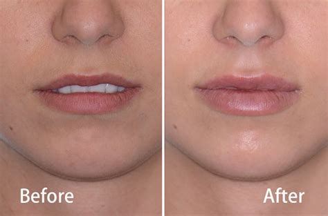 Juvederm® Lips Fillers - Facial Cosmetic Surgery - Dr. Antipov