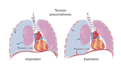 Pneumothorax | Concise Medical Knowledge