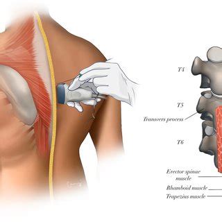 Schematic illustration of an ultrasound-guided erector spinae plane ...