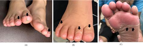 Children | Free Full-Text | Desquamation in Kawasaki Disease