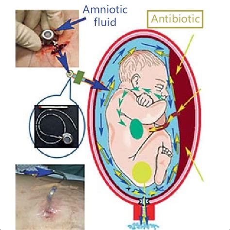 Histologic examination of the chorioamniotic membranes after PPROM ...