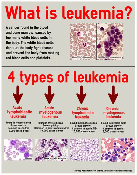 LEUKEMIA: CAUSES , SYMPTOMS, AND TREATMENT