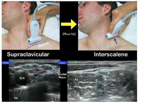 Ultrasound-Guided Interscalene Brachial Plexus Nerve Block – Core EM