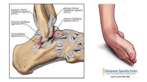 3 Ligaments Of The Lateral Ankle : Injury to any of these ligaments may ...