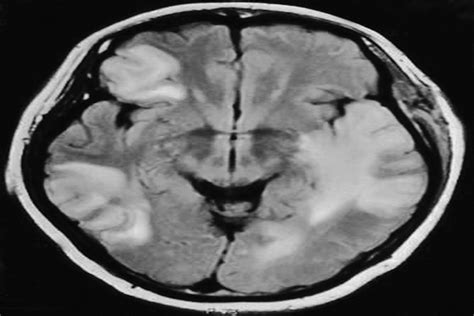 A Case of Hashimoto Encephalopathy: Clinical Manifestation,... : The ...