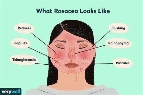 Rosacea On Neck