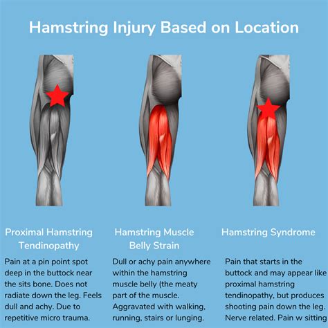 Running Injury Spotlight: Hamstrings — The Run Rx