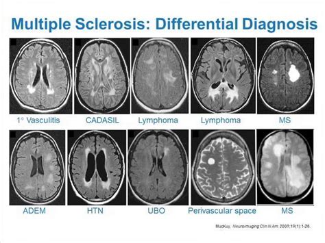 ms symptoms but normal mri - Captions Definition