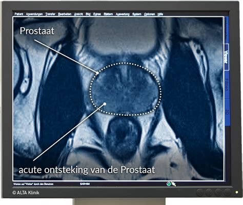 MRI Prostaat - ALTA Klinik