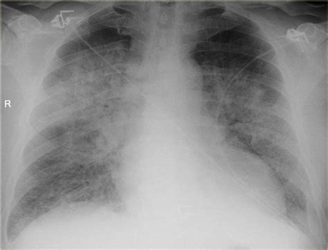 The Radiology Assistant : Chest X-Ray - Heart Failure