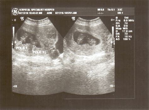 Twin Ultrasound 8 Weeks