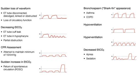 End-Tidal Waveform Capnography