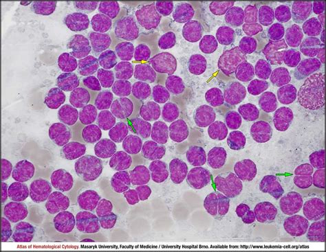 Follicular lymphoma - CELL - Atlas of Haematological Cytology