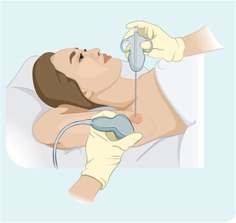 Lymph node biopsy - Lymphoma Australia