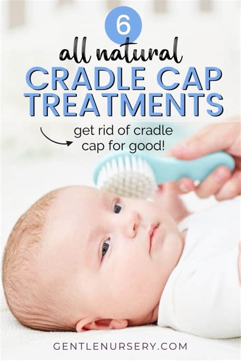 6 Best Natural Treatments for Baby Dandruff and Cradle Cap