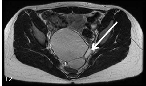 Ovarian Dermoid Cyst MRI | RADIOLOGYPICS.COM