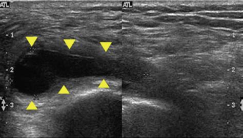 Ischial bursitis definition, causes, symptoms, diagnosis & treatment