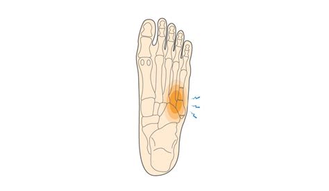 New shoes, immediate 5th metatarsal area pain, what does it mean? : r ...