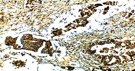 Moderately differentiated mucinous adenocarcinoma with anti S100A4 ...