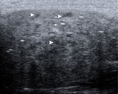 Imaging Evaluation of Pediatric Parotid Gland Abnormalities | RadioGraphics