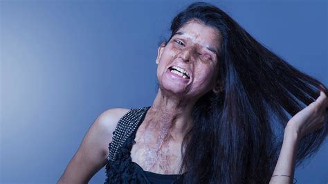 Acid victims' photo shoot draws attention in India - ABC13 Houston