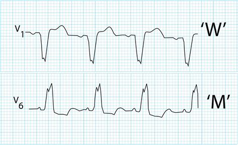 Right Bundle Branch Block Causes / Ecg Ekg Bundle Branch Block Oxford ...