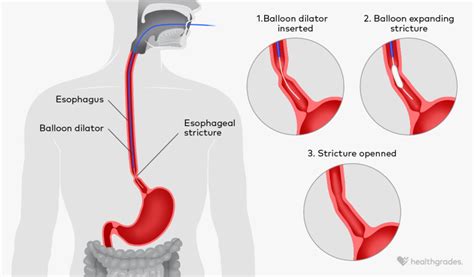 Esophageal Stricture: Causes, Symptoms, Treatments, and More