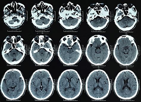 What is a Head CT scan? | Two Views