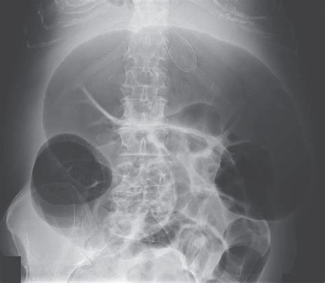 Acute Colonic Pseudo-Obstruction | NEJM