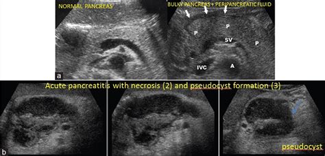 MEDICAL ULTRASOUND/ACUTE PANCREATITIS