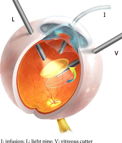 [PDF] 23-Gauge Pars Plana Vitrectomy Alone by a Bimanual Technique for ...