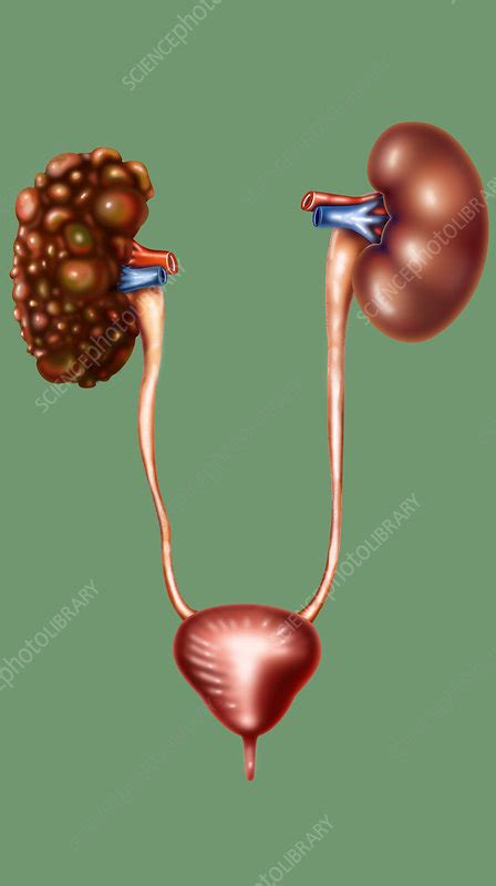 Polycystic Kidney Disease - Stock Image - F031/6967 - Science Photo Library