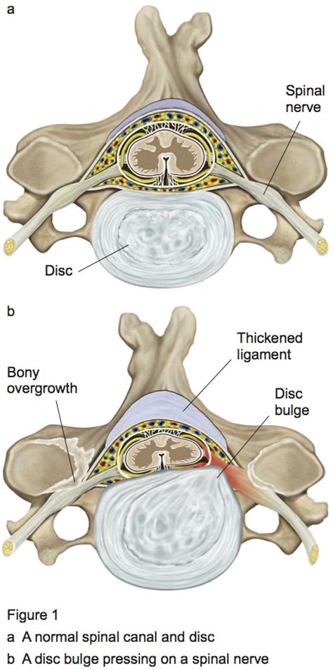 Cervical Laminectomy | New Victoria Hospital