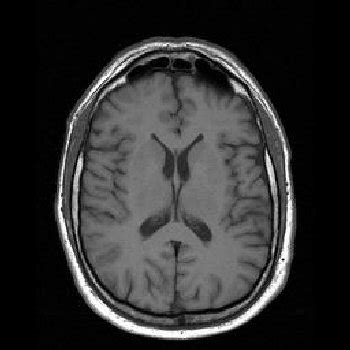 MRI Images - Brain MRI Transversal T1 002 - MR-TIP.com