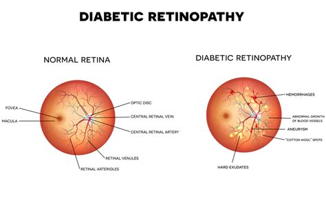 Diabetic Retinopathy Causes and Diagnosis | FLEI