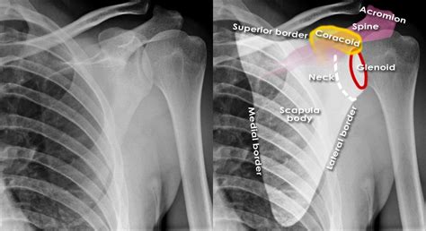 Trauma X Ray Upper Limb Gallery 1 Scapula Fractures | Porn Sex Picture