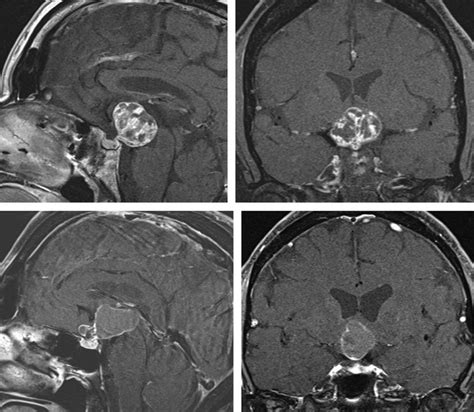 Craniopharyngioma | Expert Surgeon | Aaron Cohen-Gadol, MD