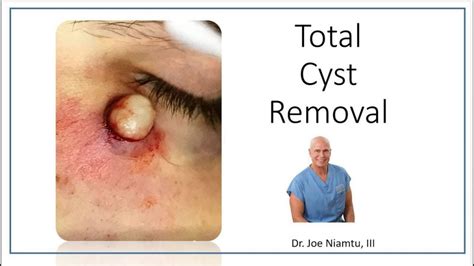 Total Removal of Facial Cyst