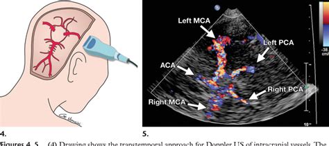 Transcranial Doppler Ultrasound