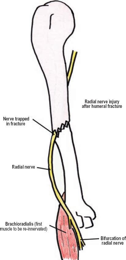 Radial Groove Radial Nerve